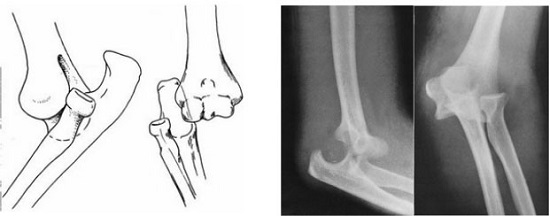 Gãy khuỷu tay - Hình ảnh minh họa